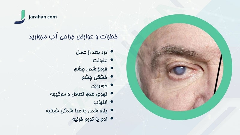 خطرات و عوارض جراحی آب مروارید